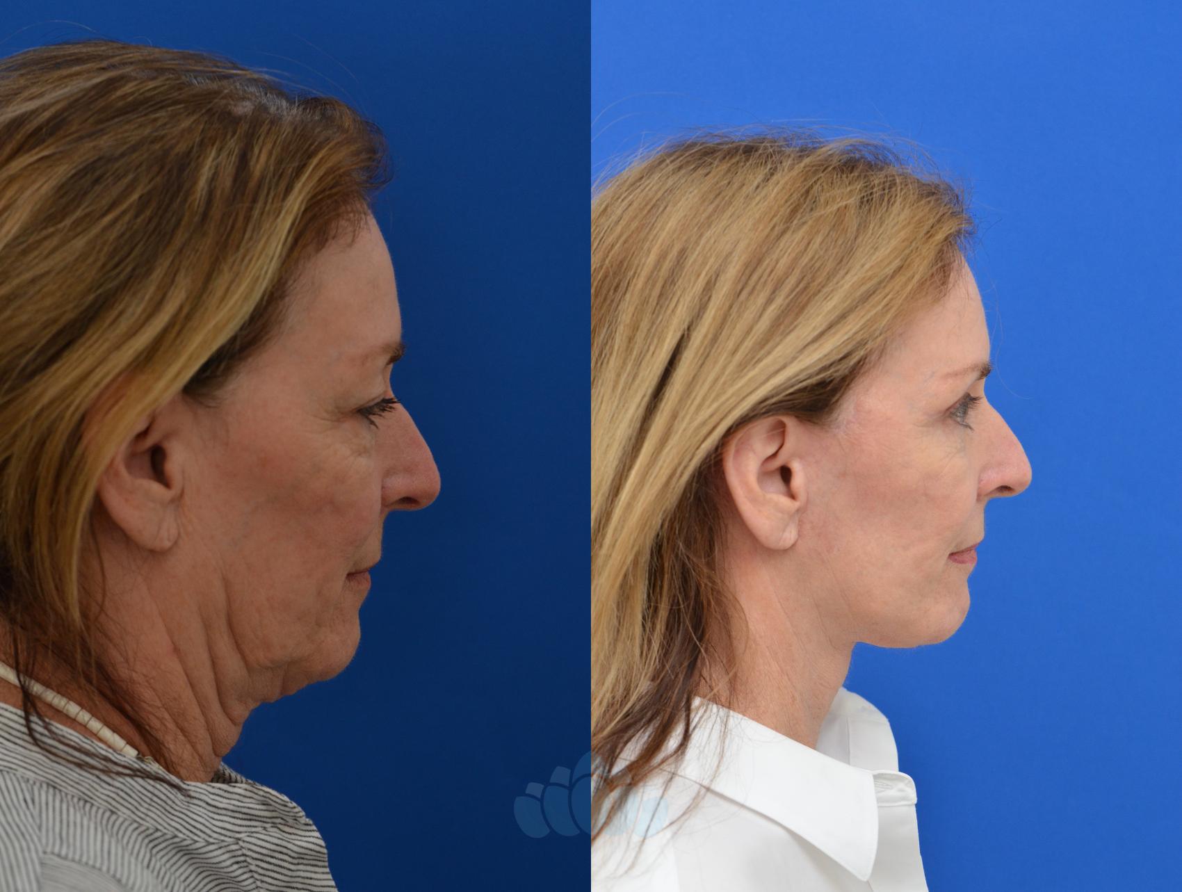 Before & After Facelift Case 12 Right Side View in Charlotte, NC