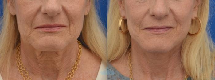 Before & After Facelift Case 127 Front View in Charlotte, NC