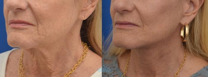Before & After Facelift Case 127 Left Oblique View in Charlotte, NC