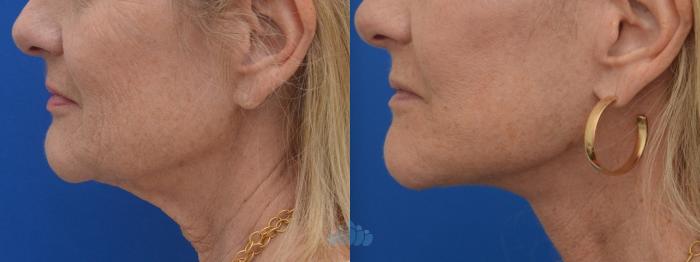 Before & After Facelift Case 127 Left Side View in Charlotte, NC