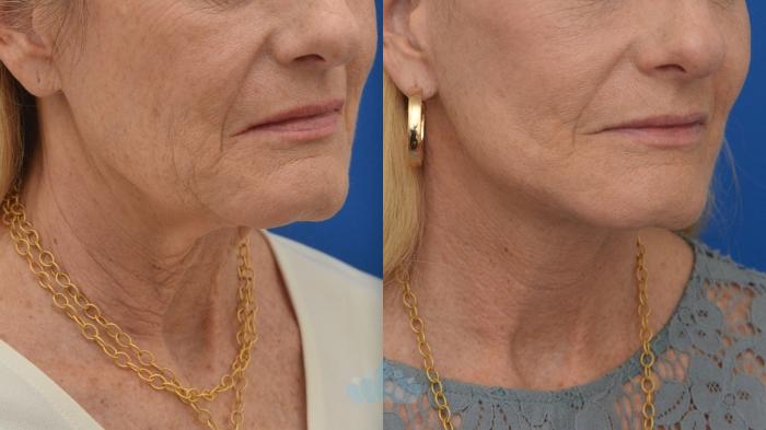 Before & After Facelift Case 127 Right Oblique View in Charlotte, NC