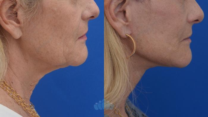 Before & After Facelift Case 127 Right Side View in Charlotte, NC
