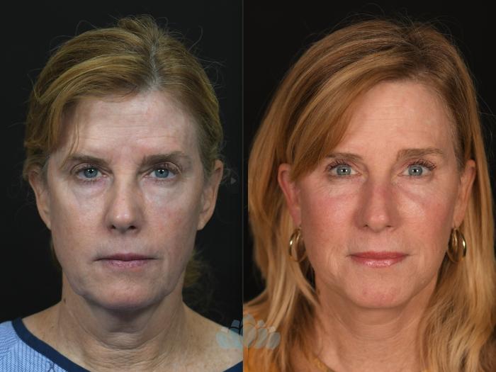 Before & After Facial Fat Grafting Case 130 Front View in Charlotte, NC