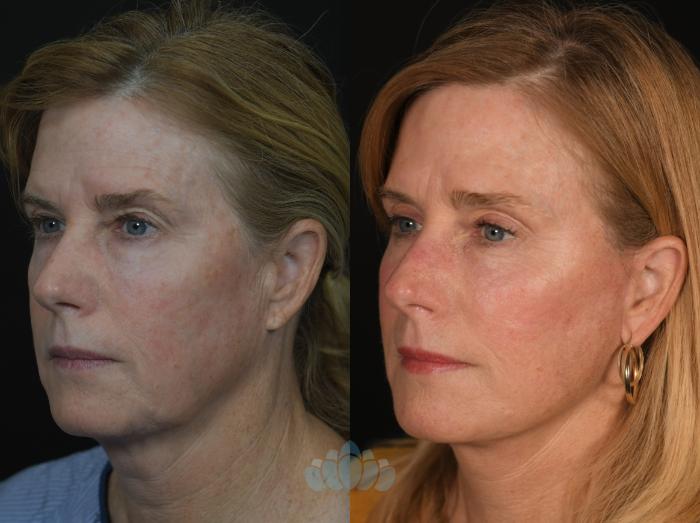 Before & After Facial Fat Grafting Case 130 Left Oblique View in Charlotte, NC
