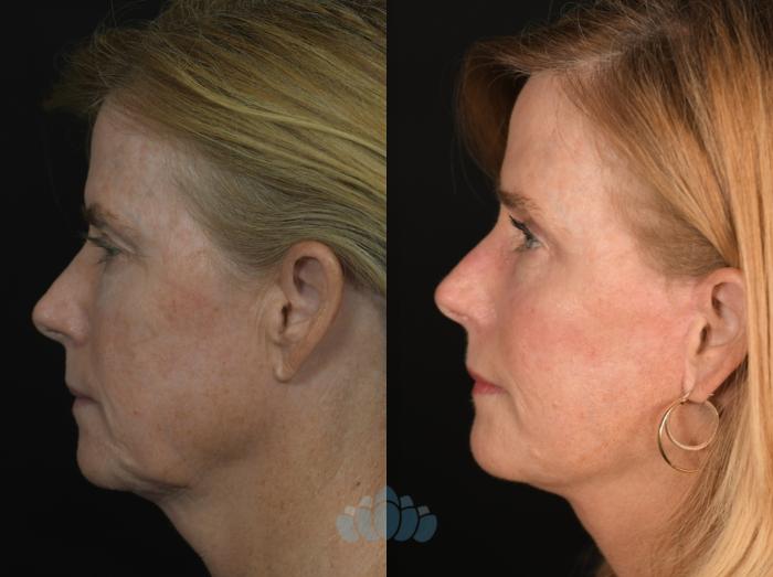 Before & After Facial Fat Grafting Case 130 Left Side View in Charlotte, NC