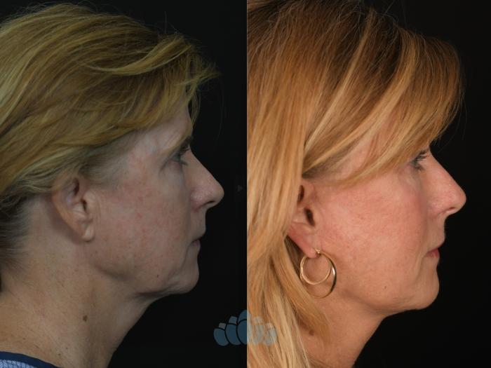 Before & After Facial Fat Grafting Case 130 Right Oblique View in Charlotte, NC