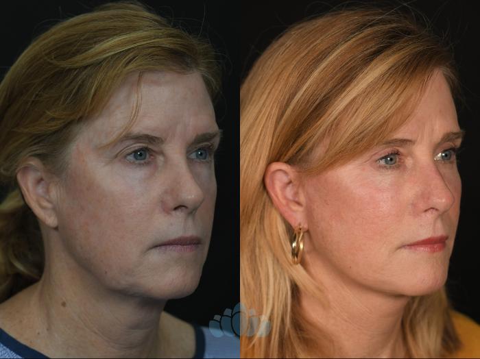 Before & After Facial Fat Grafting Case 130 Right Side View in Charlotte, NC