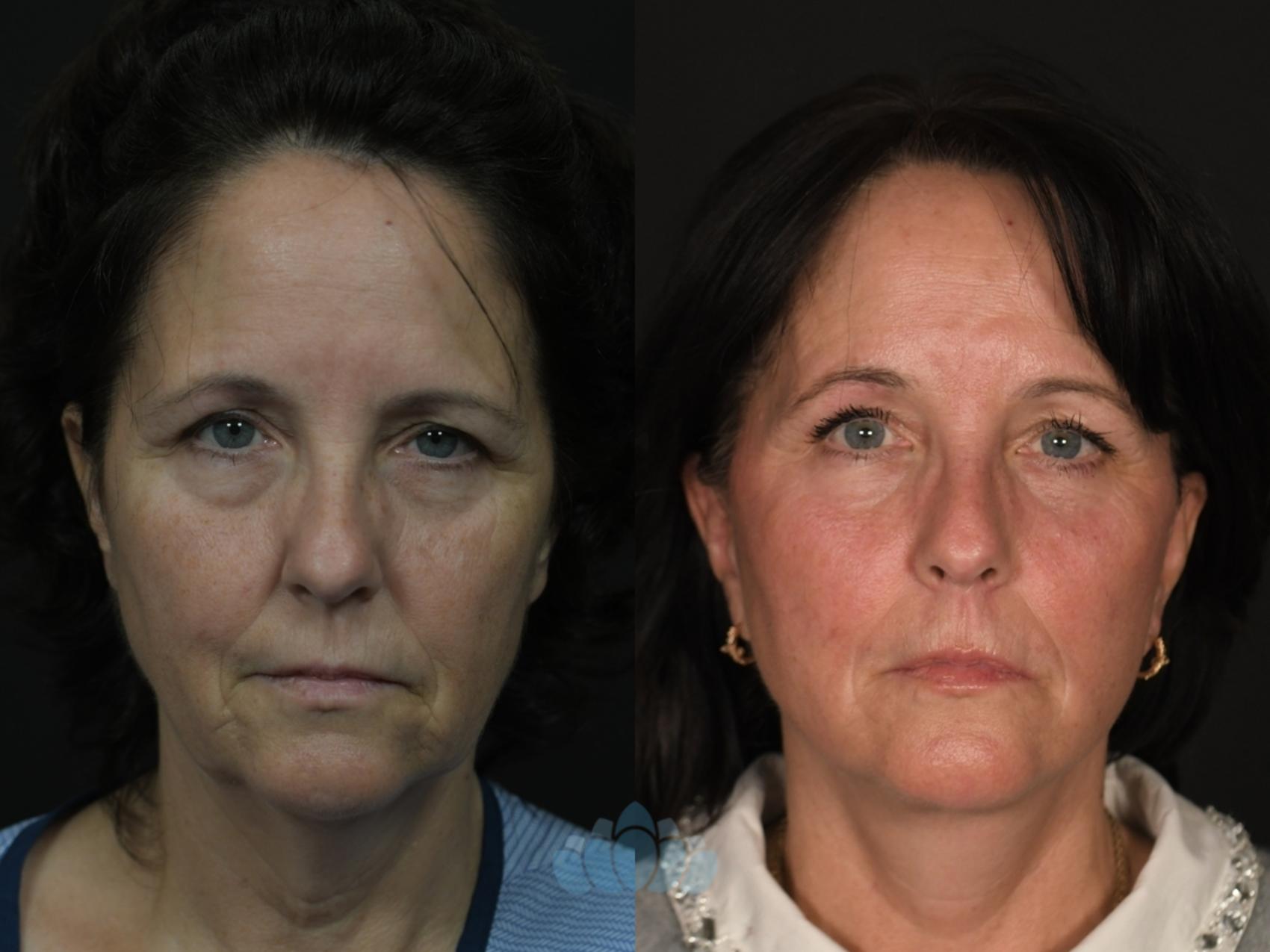 Before & After Facial Fat Grafting Case 131 Front View in Charlotte, NC