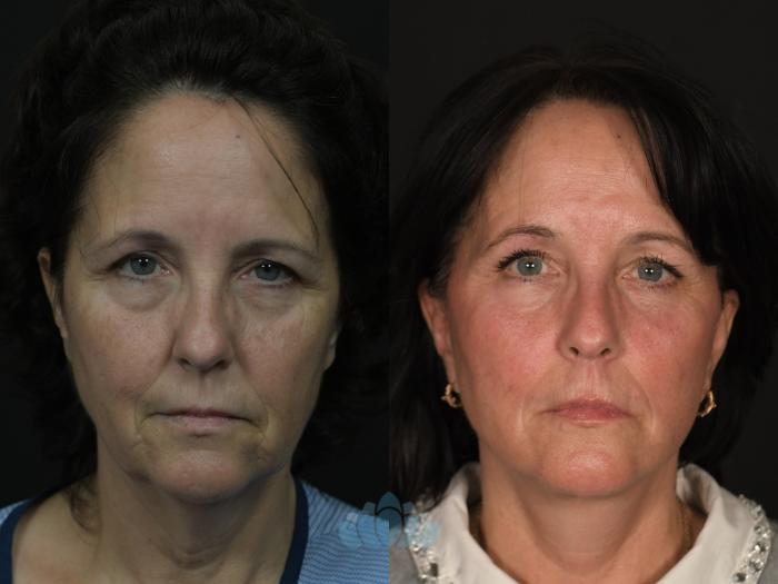 Before & After Facial Fat Grafting Case 131 Front View in Charlotte, NC