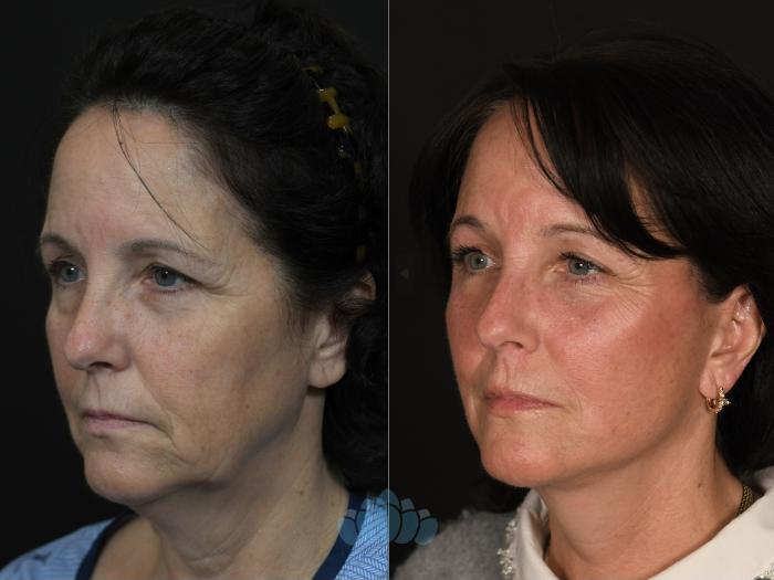 Before & After Facial Fat Grafting Case 131 Left Oblique View in Charlotte, NC