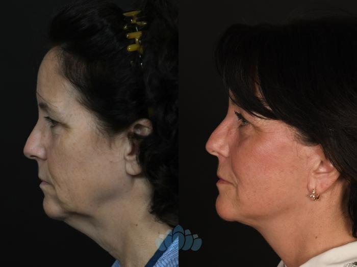 Before & After Facial Fat Grafting Case 131 Left Side View in Charlotte, NC