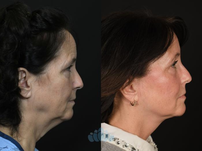 Before & After Facial Fat Grafting Case 131 Right Oblique View in Charlotte, NC