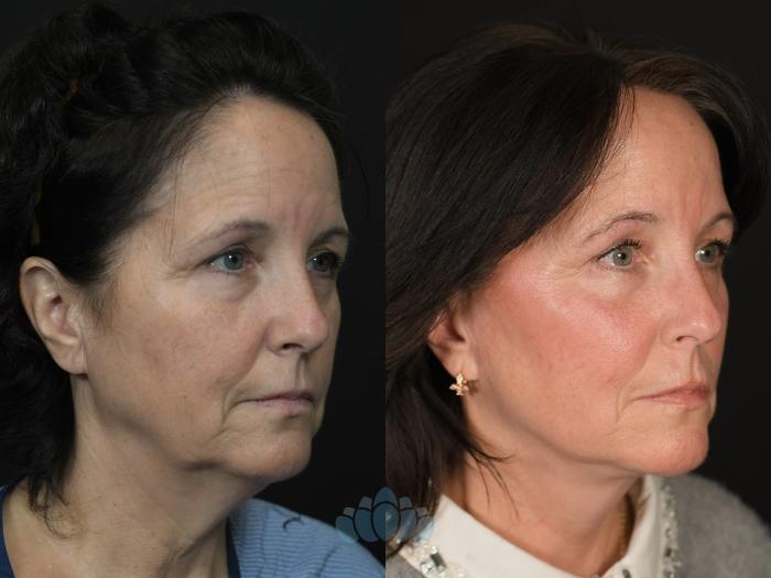 Before & After Facial Fat Grafting Case 131 Right Side View in Charlotte, NC