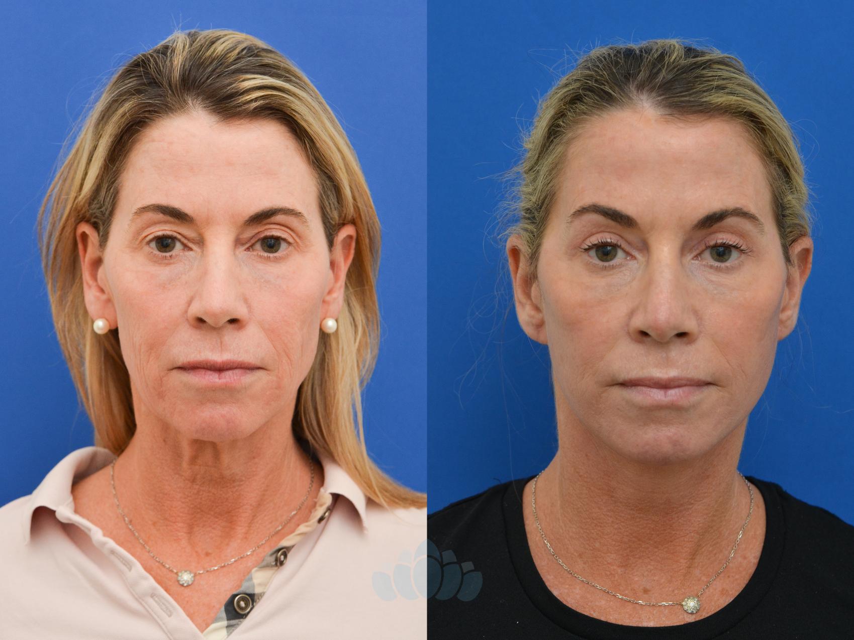 Facelift Before and After Photos