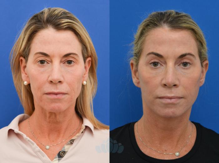 Before & After Eyelid Surgery Case 50 Front View in Charlotte, NC
