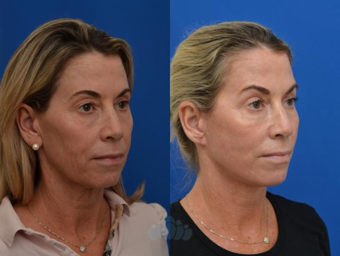 Before & After Facelift Case 50 Right Oblique View in Charlotte, NC