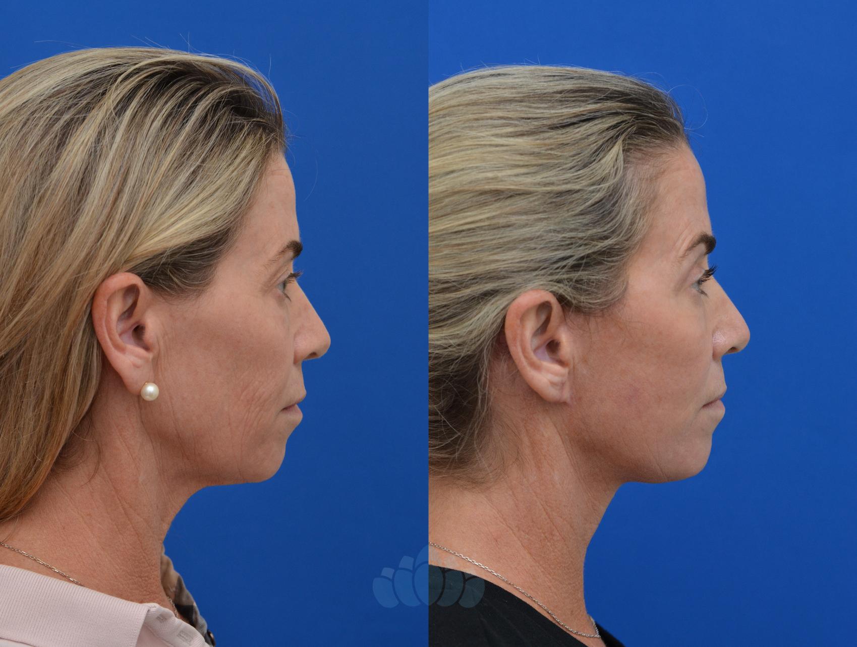 Before & After Facelift Case 50 Right Side View in Charlotte, NC
