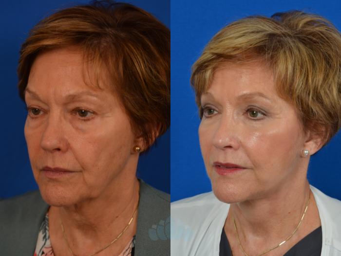 Before & After Eyelid Surgery Case 51 Left Oblique View in Charlotte, NC