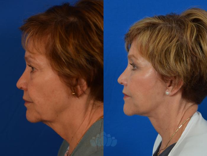 Before & After Eyelid Surgery Case 51 Left Side View in Charlotte, NC
