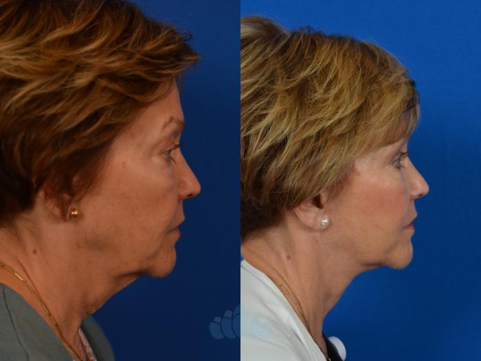 Before & After Neck Lift Case 51 Right Side View in Charlotte, NC