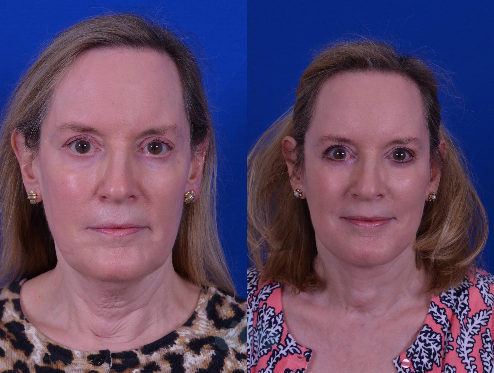 Skin Tightening Before & After - Charlotte Huntersville, NC