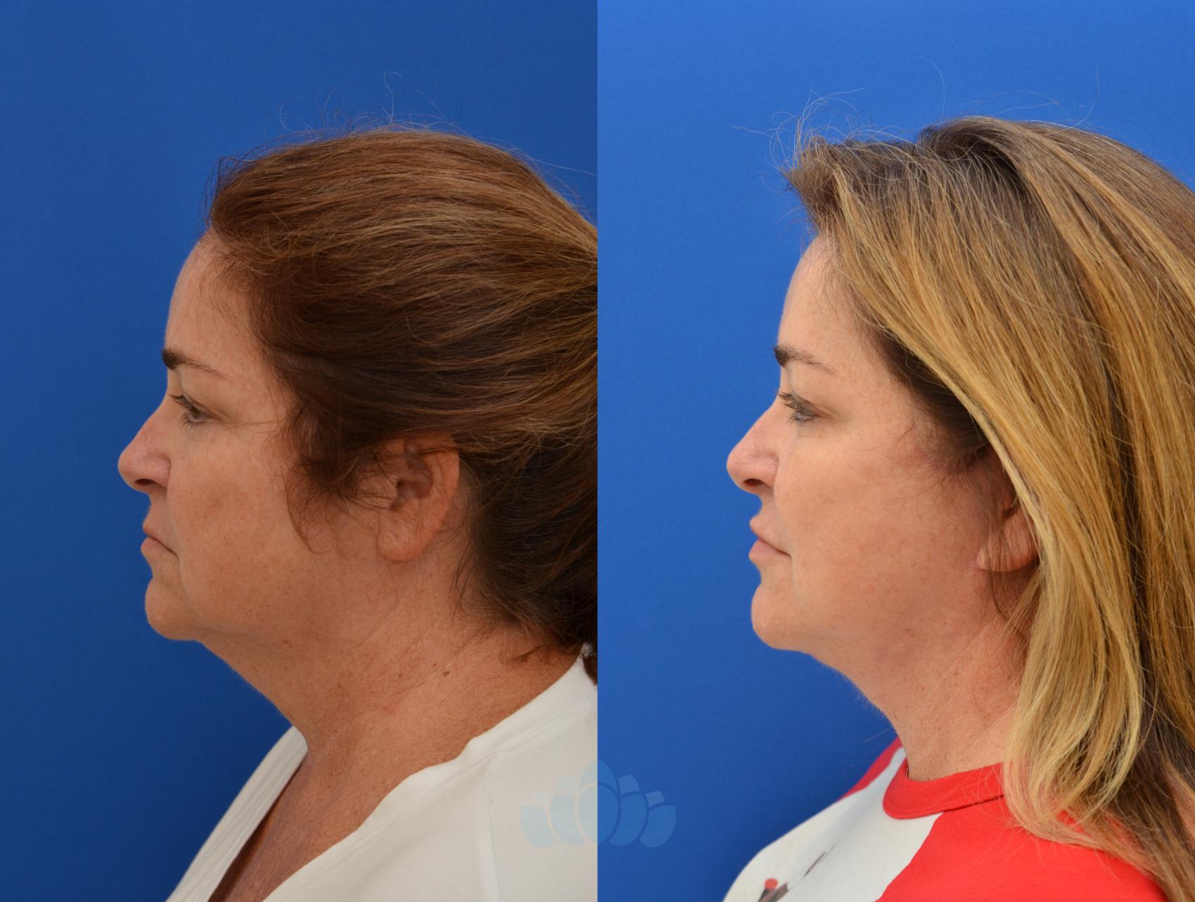 Deep Plane Facelift - Before