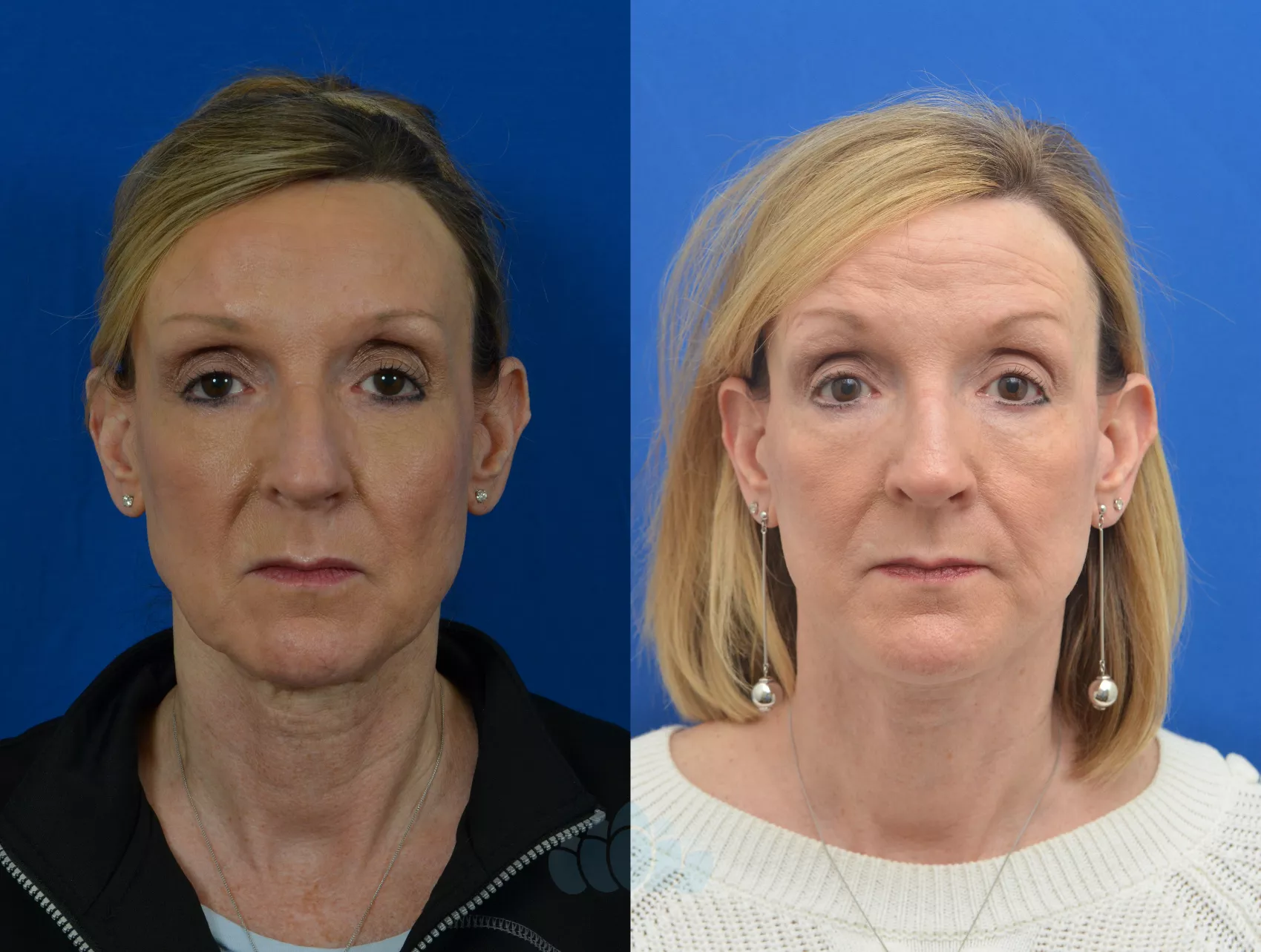 Facelift Before and After Pictures Case 68, Charlotte, NC