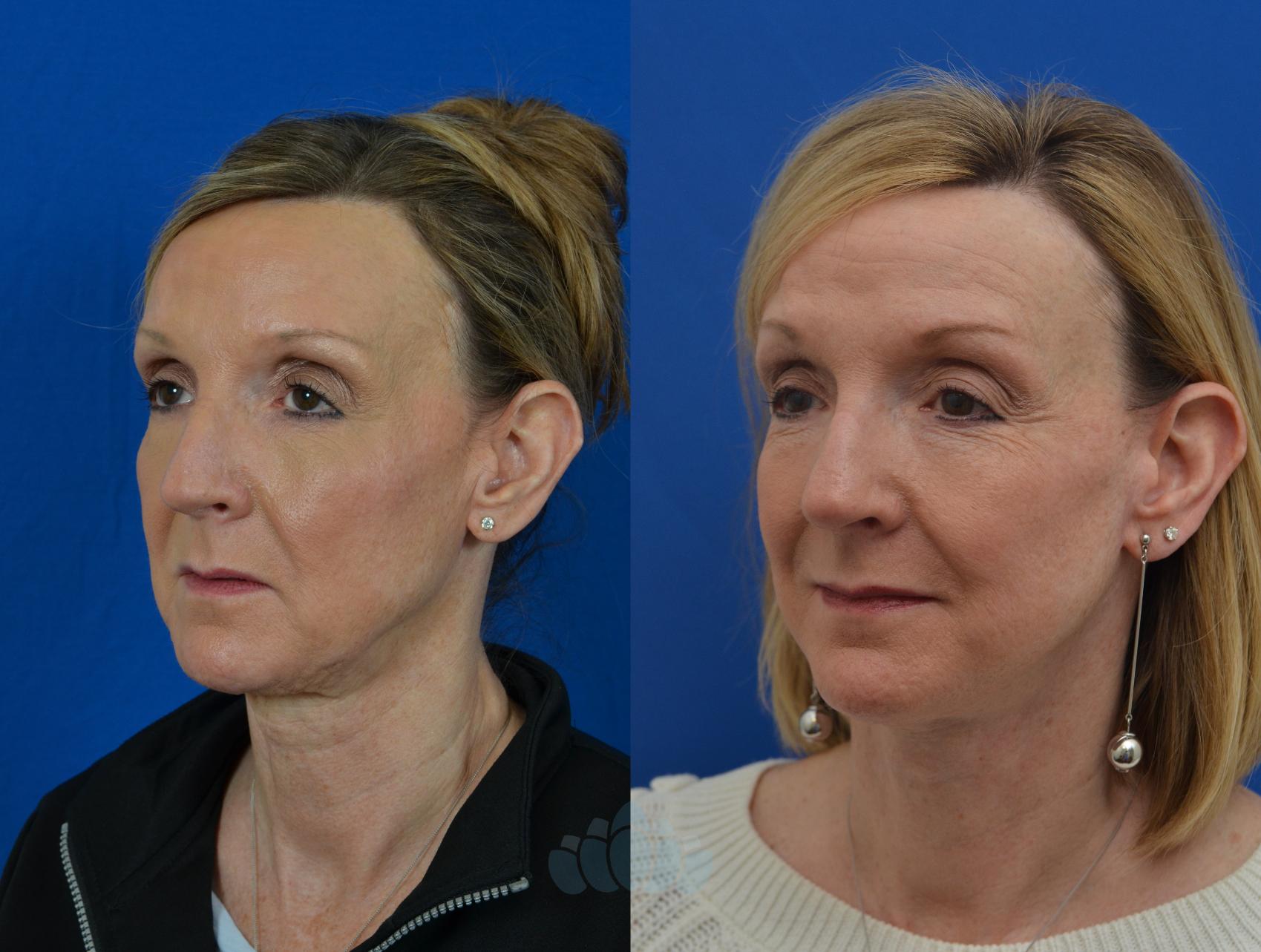 Deep Plane Facelift - Before