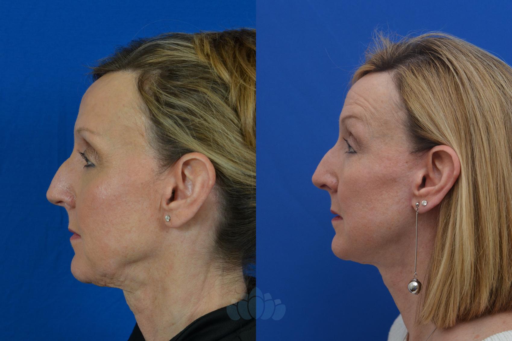 Deep Plane Facelift - Before