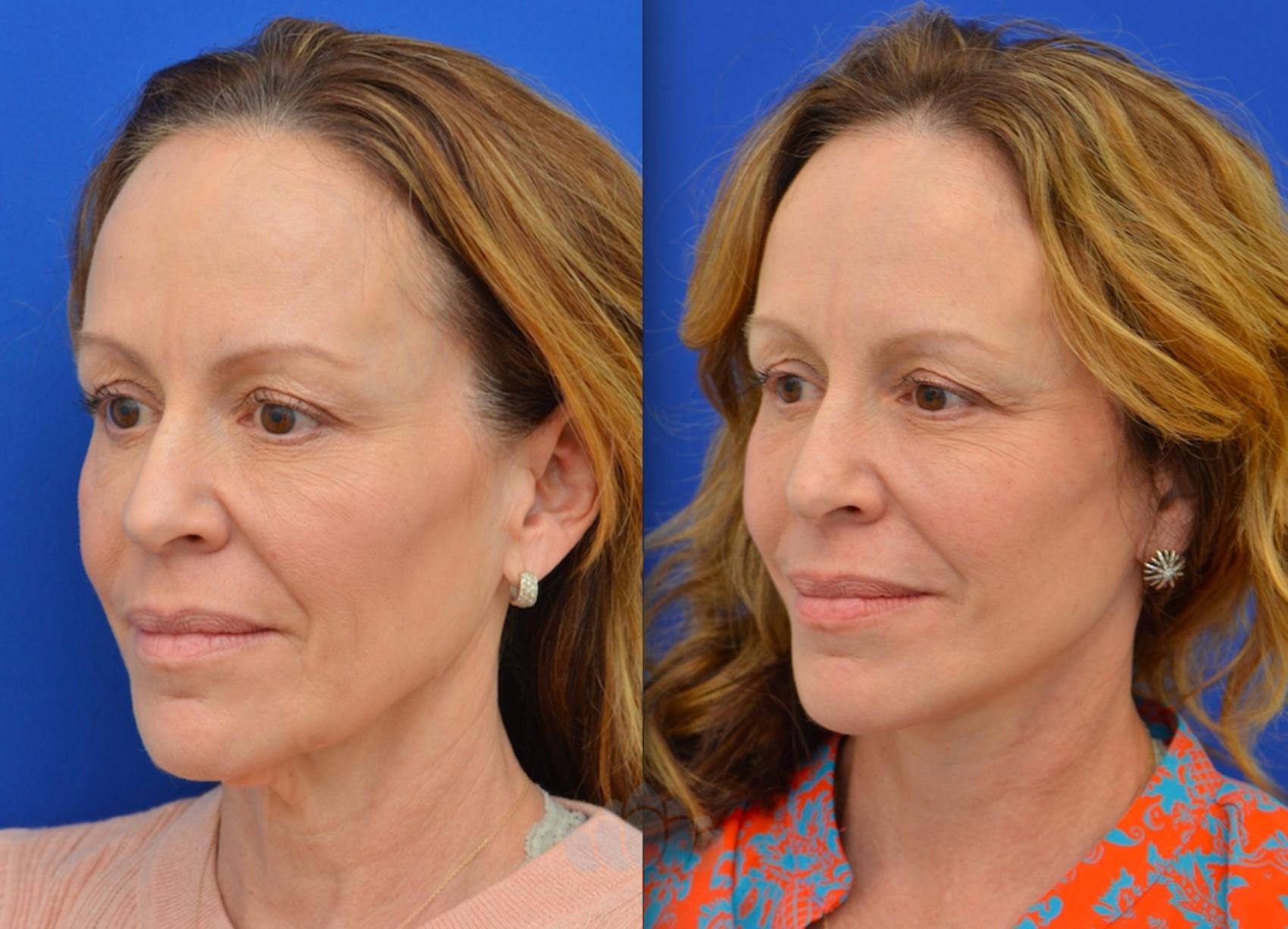 Before & After Facelift Case 90 Left Oblique View in Charlotte, NC