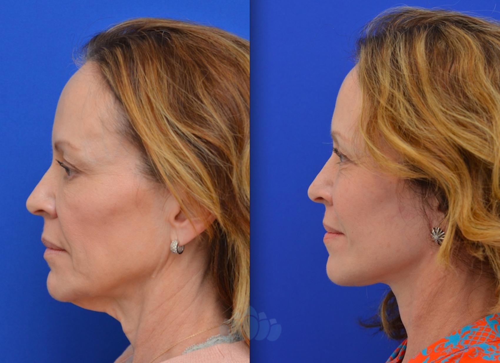Before & After Facelift Case 90 Left Side View in Charlotte, NC