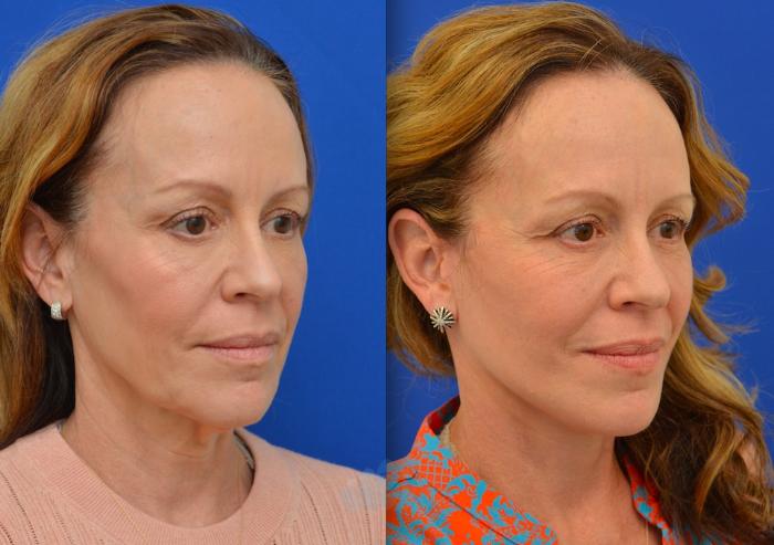 Before & After Facelift Case 90 Right Oblique View in Charlotte, NC