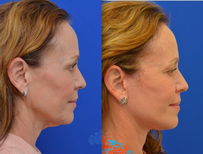 Before & After Facelift Case 90 Right Side View in Charlotte, NC