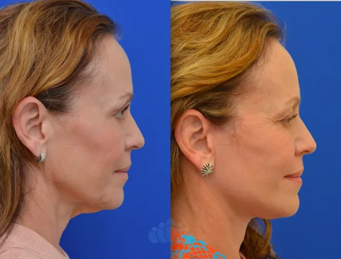 Facelift Before and After Pictures Case 90, Charlotte, NC