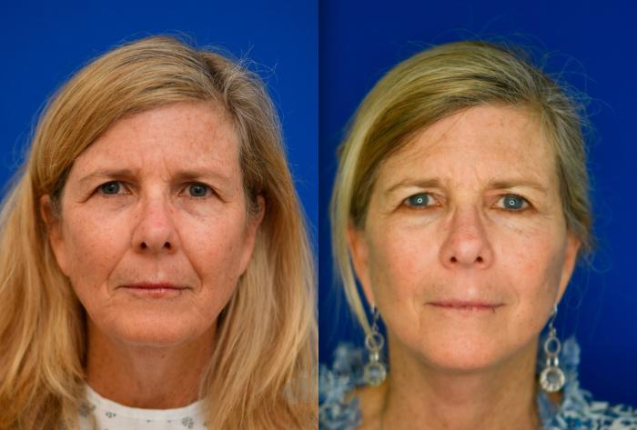 Before & After Neck Lift Case 91 Front View in Charlotte, NC