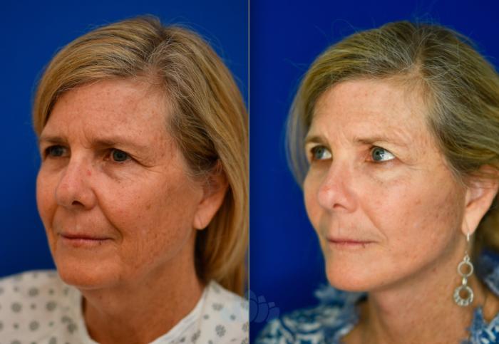 Before & After Facelift Case 91 Left Oblique View in Charlotte, NC