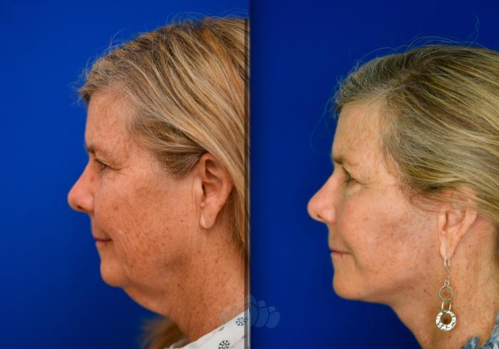 Before & After Neck Lift Case 91 Left Side View in Charlotte, NC