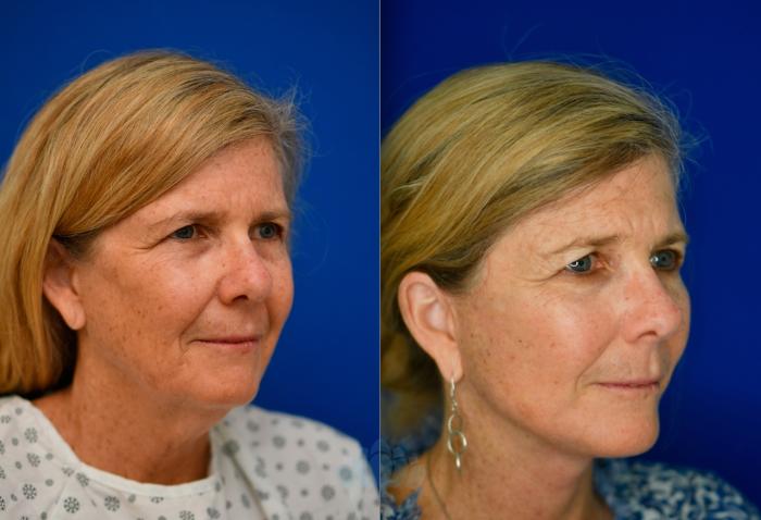 Before & After Neck Lift Case 91 Right Oblique View in Charlotte, NC