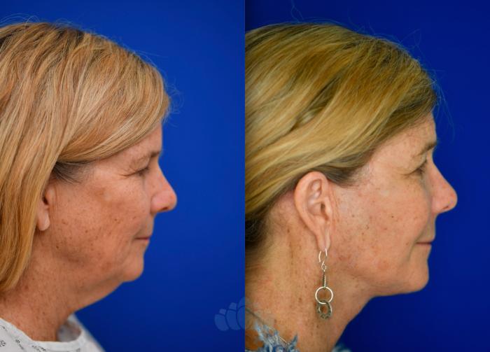 Before & After Facelift Case 91 Right Side View in Charlotte, NC