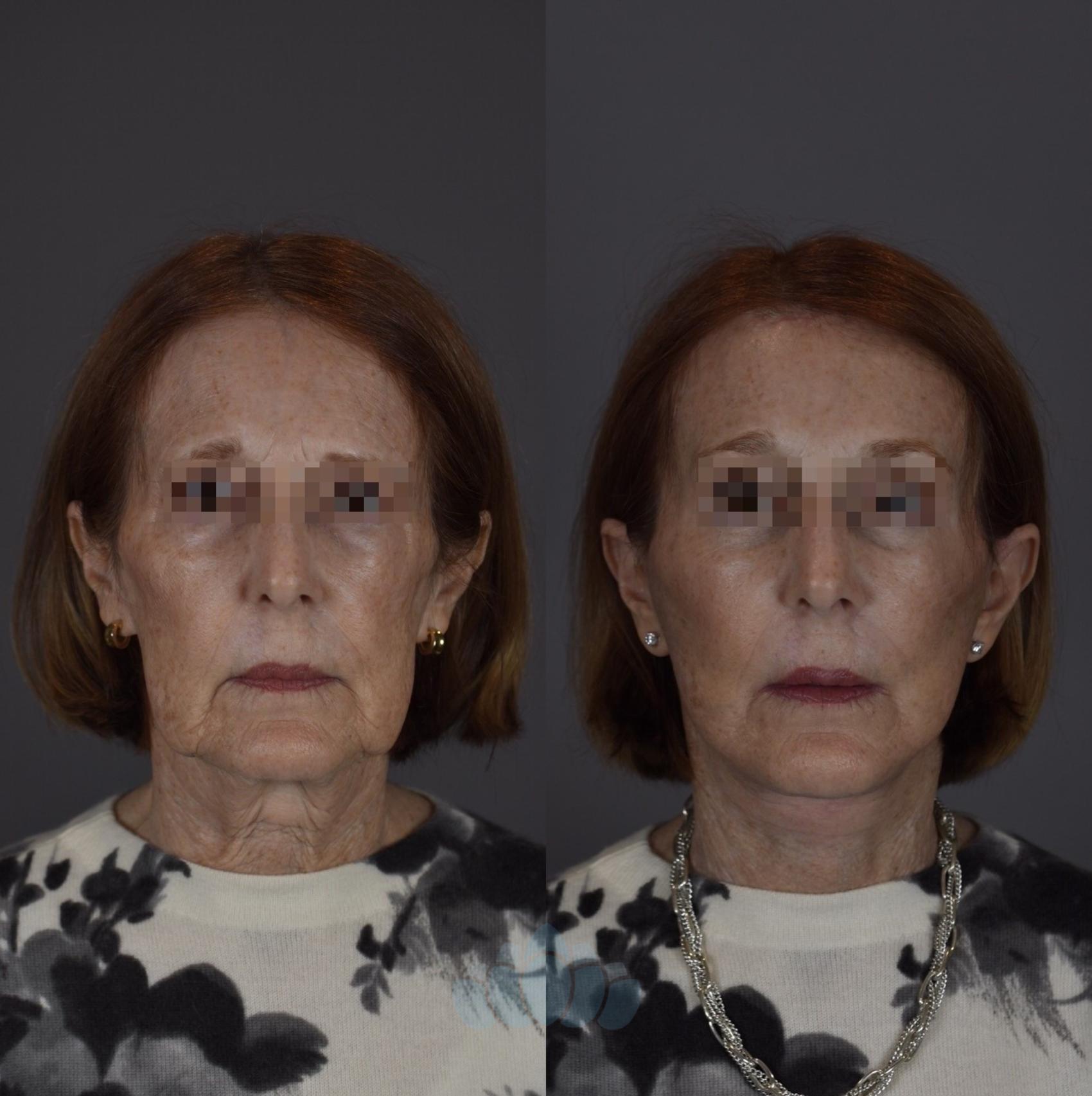 Before & After Brow Lift Case 92 Front View in Charlotte, NC