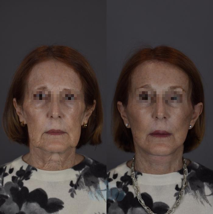 Before & After Eyelid Surgery Case 92 Front View in Charlotte, NC