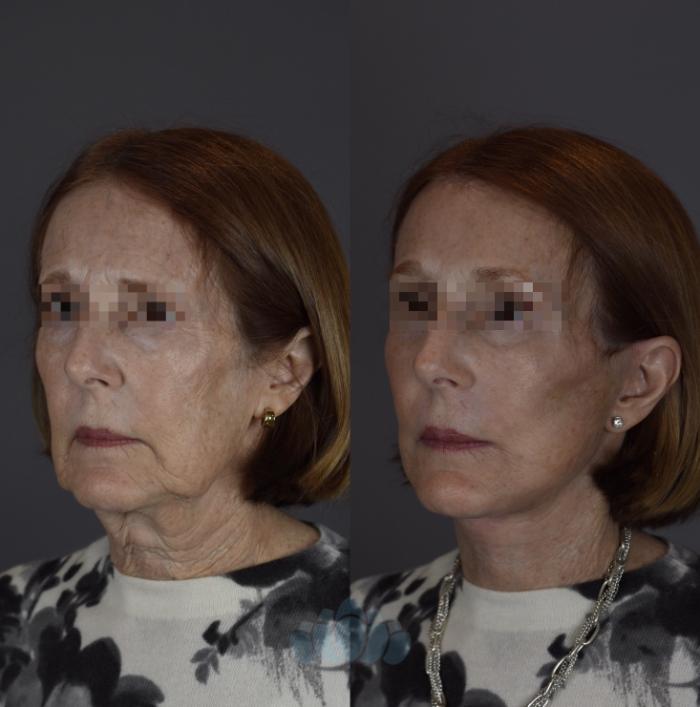Before & After Eyelid Surgery Case 92 Left Oblique View in Charlotte, NC