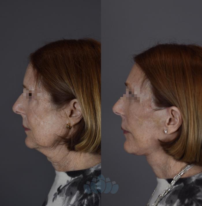 Before & After Eyelid Surgery Case 92 Left Side View in Charlotte, NC