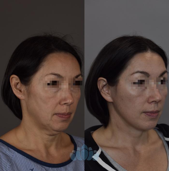 Before & After Facelift Case 93 Right Oblique View in Charlotte, NC