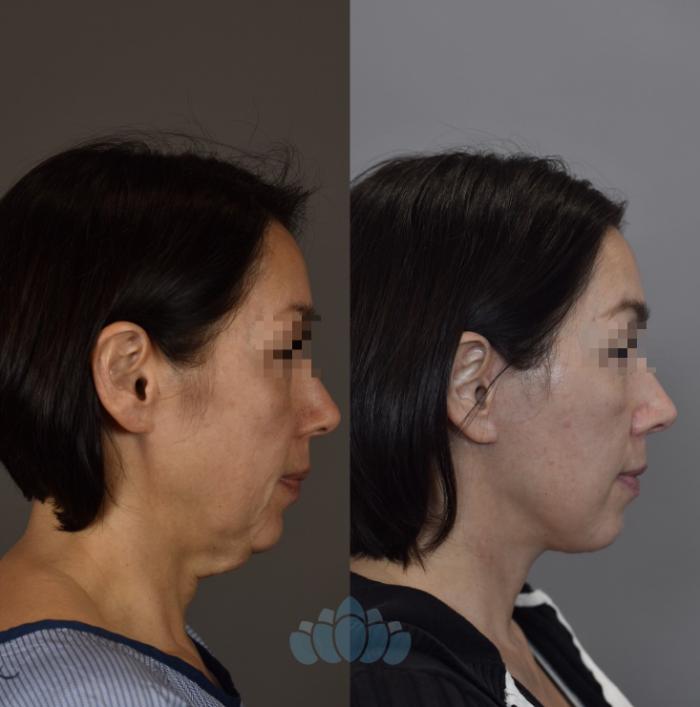 Before & After Facelift Case 93 Right Side View in Charlotte, NC