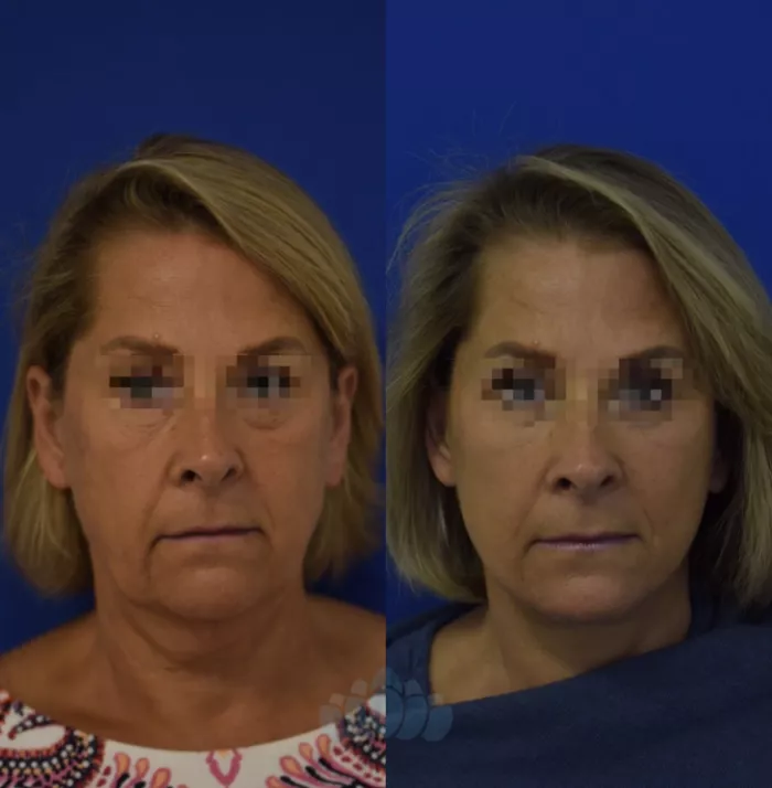 Foglietti Natural (Vector) Facelift℠ Before After Photos Cleveland