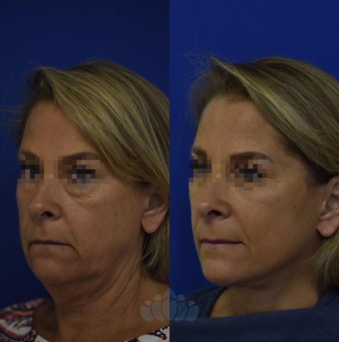 Before & After Facelift Case 94 Left Oblique View in Charlotte, NC