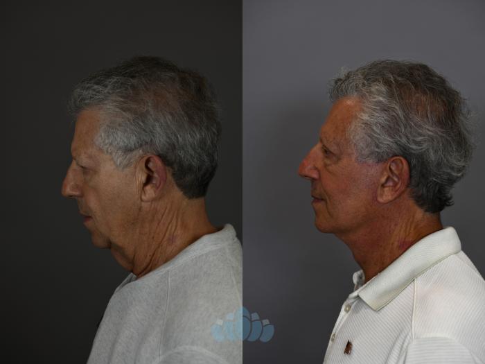 Before & After Neck Lift Case 95 Left Side View in Charlotte, NC