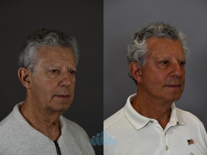 Before & After Facelift Case 95 Right Oblique View in Charlotte, NC