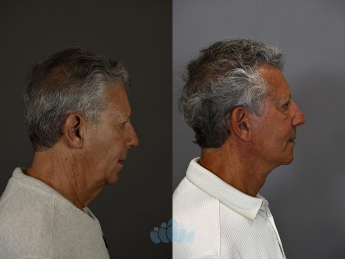 Before & After Eyelid Surgery Case 95 Right Side View in Charlotte, NC